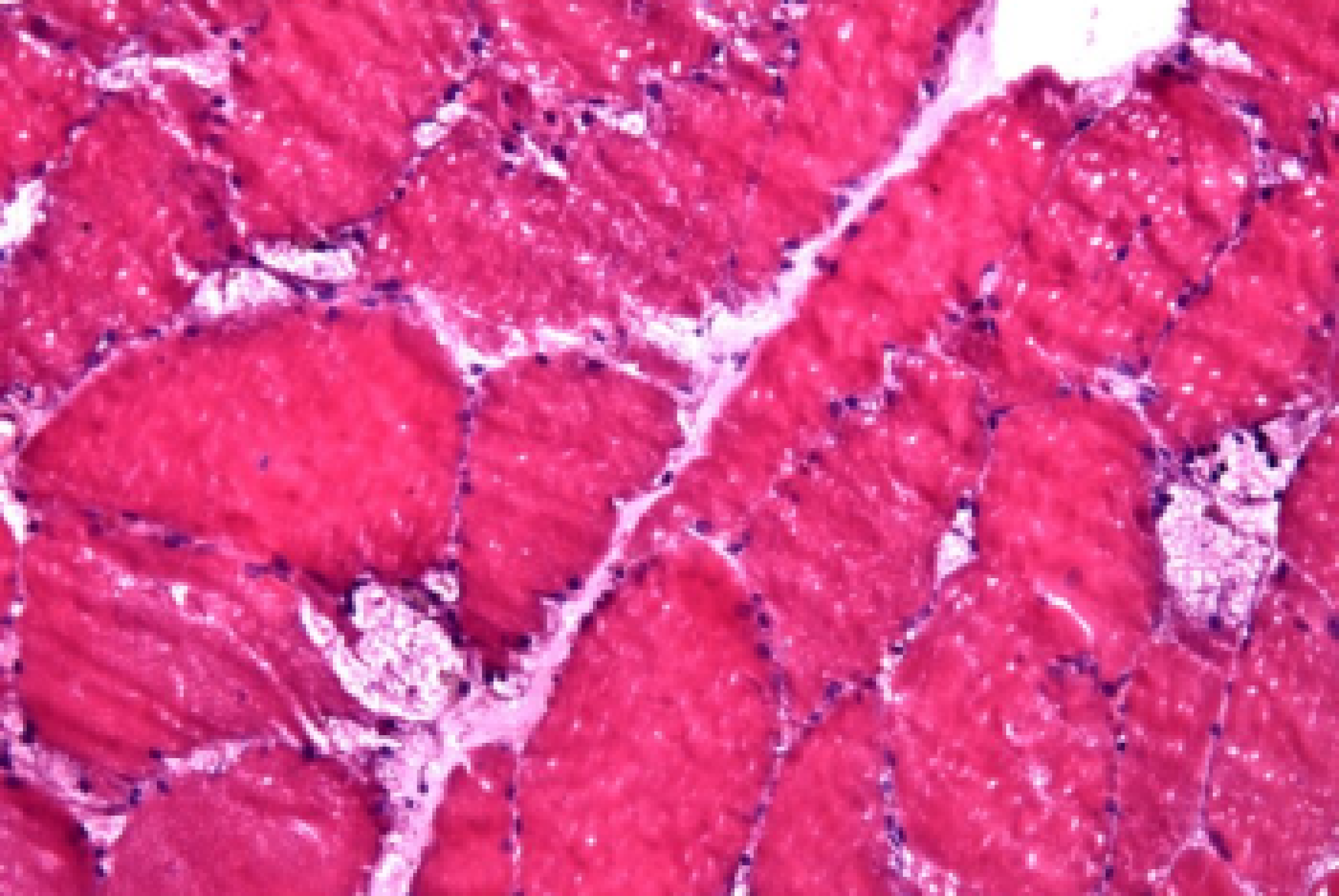 Microfotografia ottenuta tramite biopsia muscolare che evidenzia vacuoli di grandi dimensioni in un caso di malattia di Pompe (colorazione con ematossilina eosina)