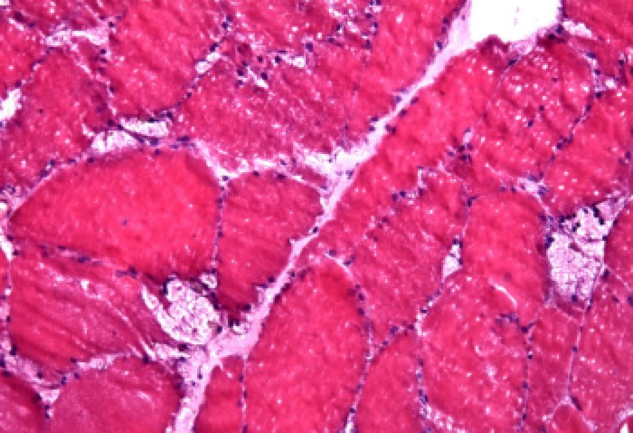 Microfotografia ottenuta tramite biopsia muscolare che evidenzia vacuoli di grandi dimensioni in un caso di malattia di Pompe (colorazione con ematossilina eosina)